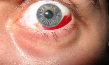 Ți s-a spart un vas de sânge la ochi? Semnul care trebuie să te trimită URGENT la medic