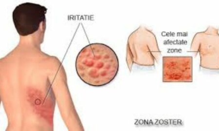 Zona Zoster. Tot ce trebuie să știm despre această boală