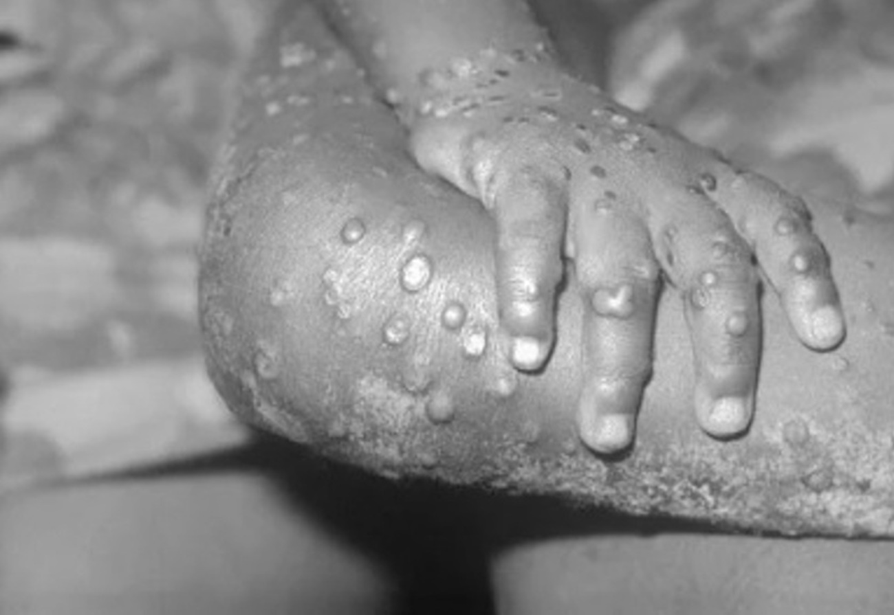 A fost anunțat primul copil diagnosticat cu variola maimuței. Cauza este alta decât cea descoperită inițial
