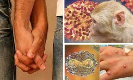 Despre “variola maimuței”, experții spun că „transmiterea este necontrolată”! Homosexualii cresc rata de incidență a bolii.