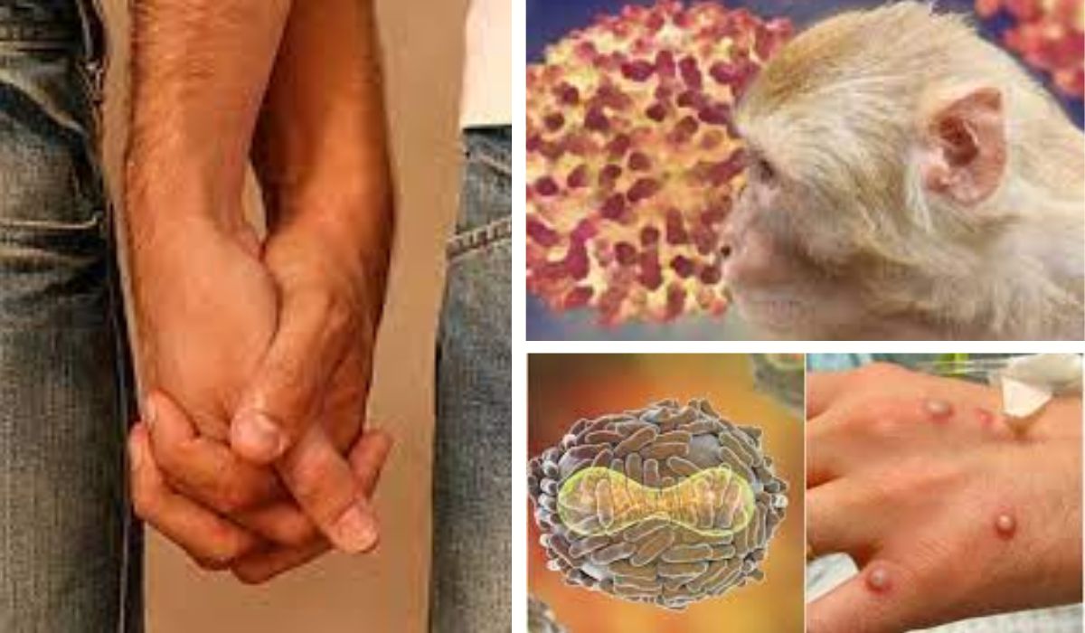 Despre “variola maimuței”, experții spun că „transmiterea este necontrolată”! Homosexualii cresc rata de incidență a bolii.