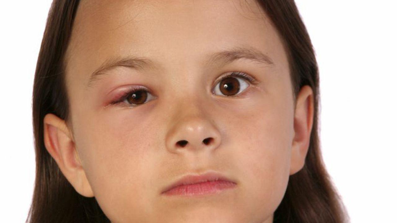 Pentru părinți: Ce spune medicul că trebuie să faceți atunci când copilul este înțepat în zona ochiului