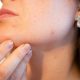 Știați că șase probleme de sănătate sunt semnalate de apariția coșurilor în anumite zone ale feței? Ce spun specialiștii