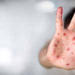 epidemie, sursa foto digi24