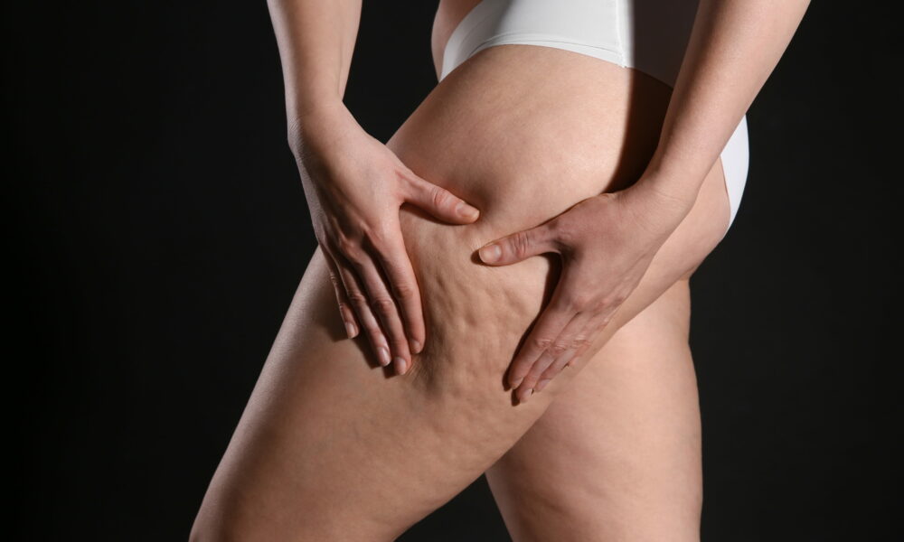 Ce este celulita, câte tipuri există și cum o tratăm