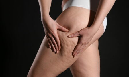 Ce este celulita, câte tipuri există și cum o tratăm